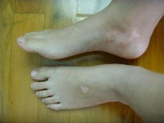 生活习惯对于白癜风的影响