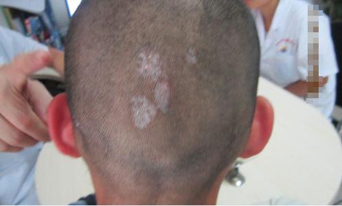 儿童患白癜风怎样调节心理