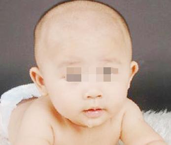 婴儿在治疗白癜风时要注意什么