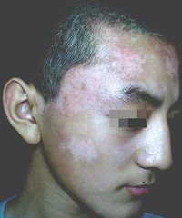 面部患白癜风会有什么症状