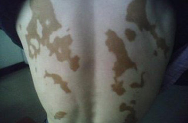 科普：白癜风可以被治好吗