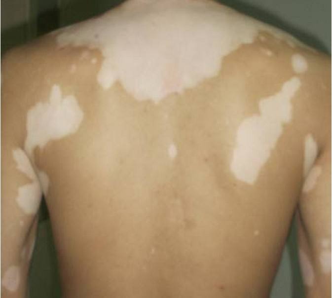 专家讲解：背部白癜风要怎么治疗？