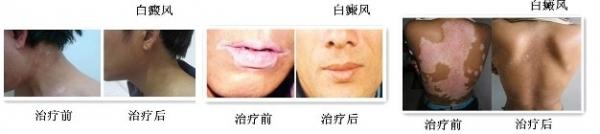 如何解救白癜风患者