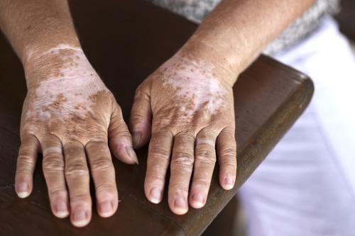 青少年治疗白癜风有什么优势