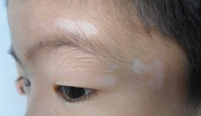 专家讲解：儿童白癜风治疗容易出现的误区