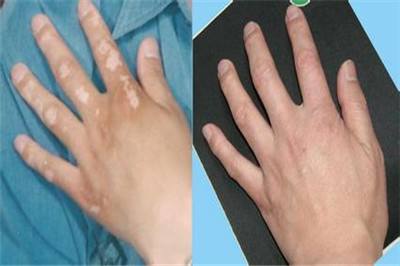 患白癜风后会有什么危害?