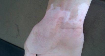 为什么就你被白癜风盯上?还不反省去