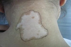 白癜风的临床症状有哪些？你知道多少