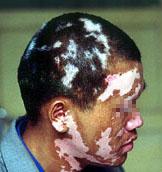 工业污染与白癜风之间的关系