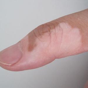 白癜风的危害有哪几种