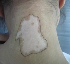 跟着小编了解下初期白癜风的治愈率有多高